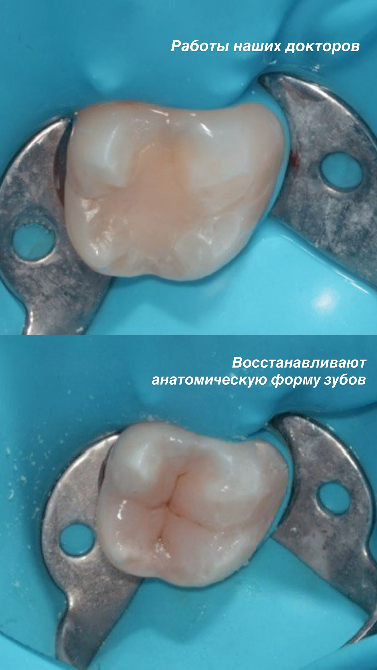 Имплантация