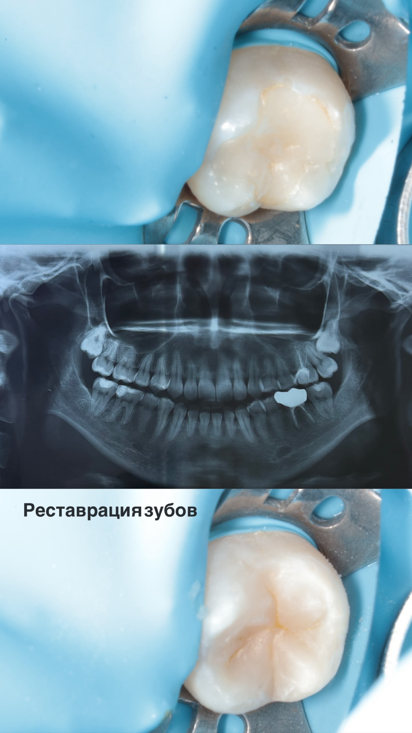 Костная пластика