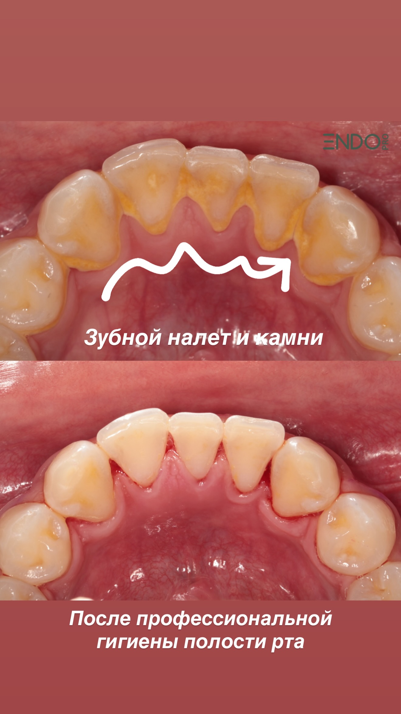 Лечение кариеса