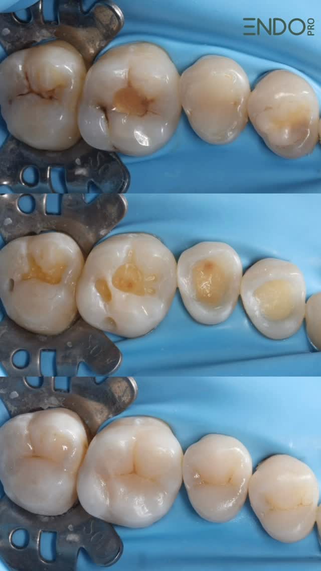 Реставрация зубов